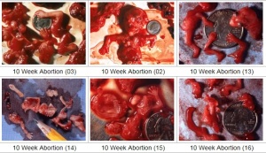 Abortion pictures